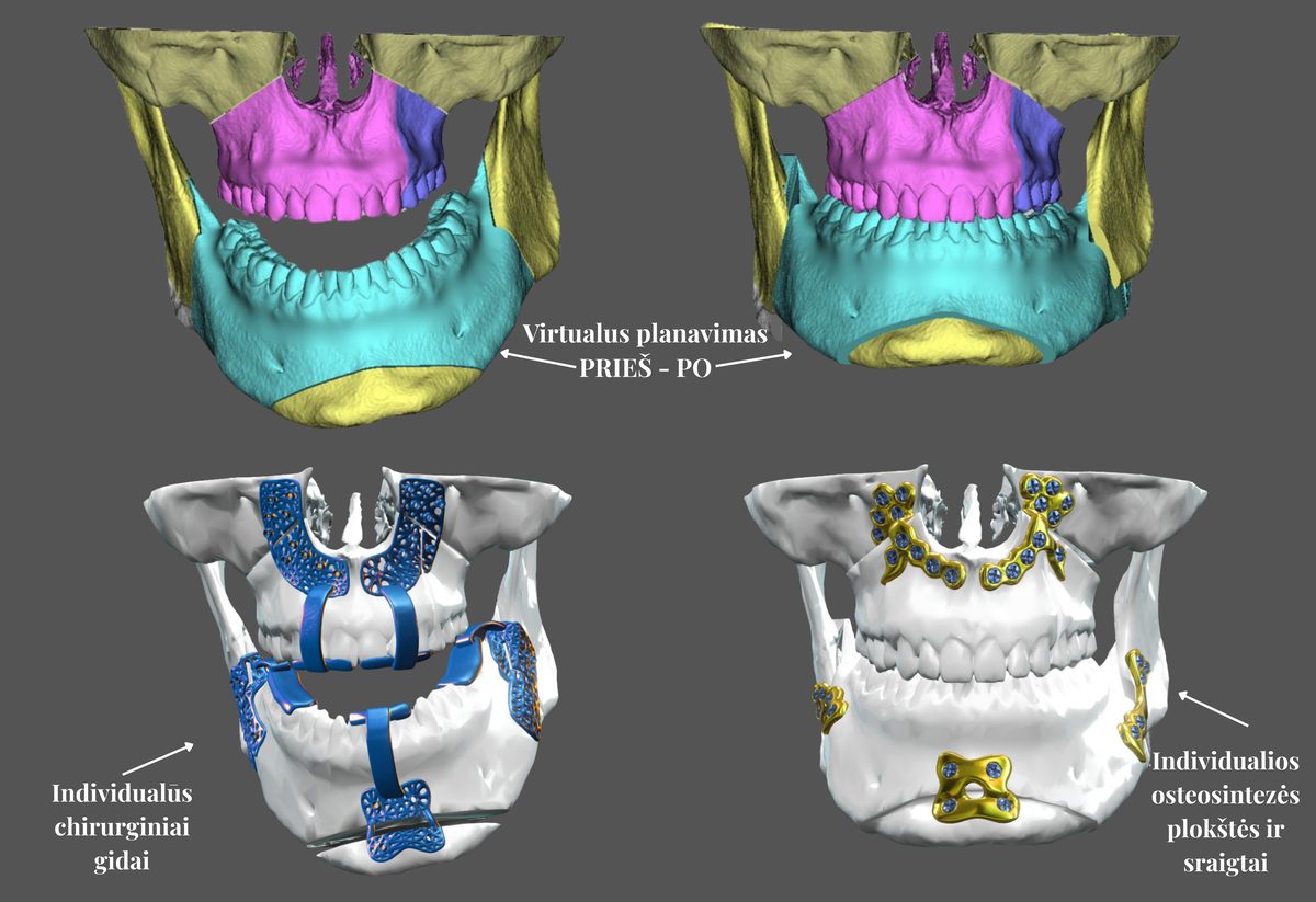 Surgery First Approach