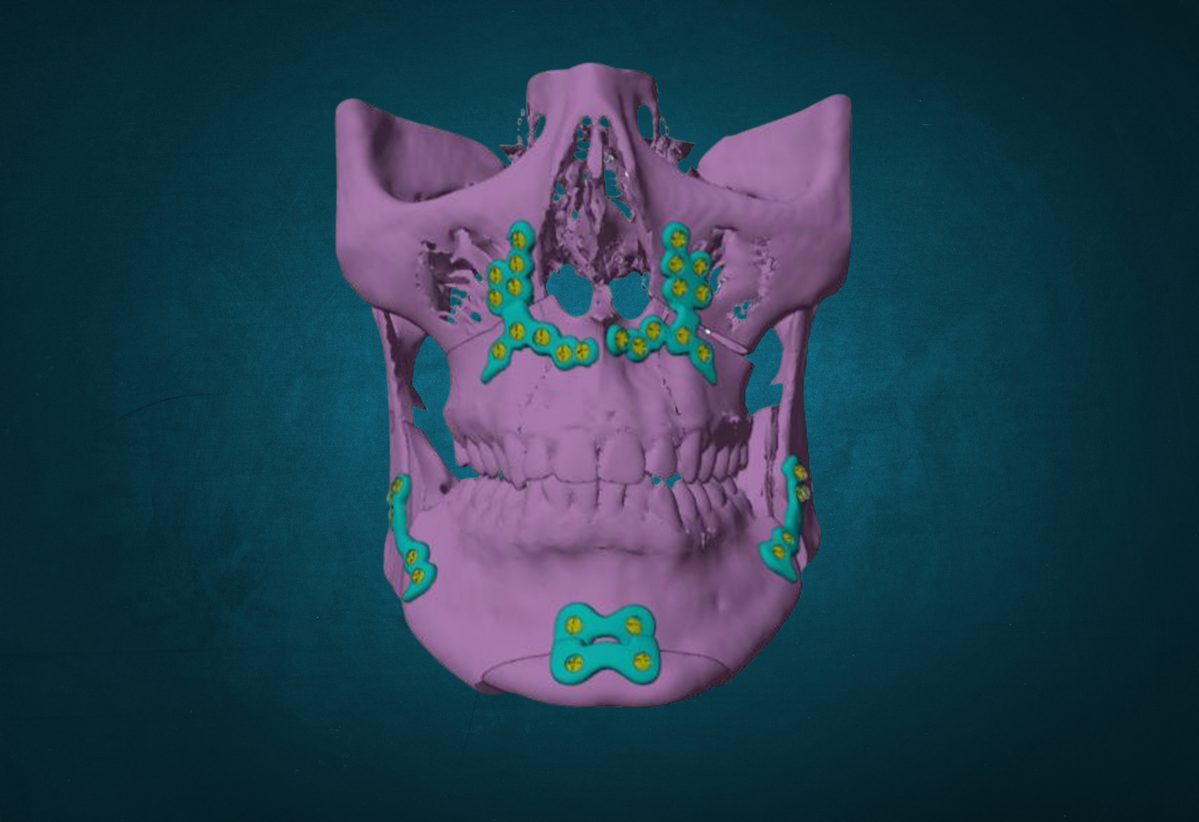 Surgery First Approach